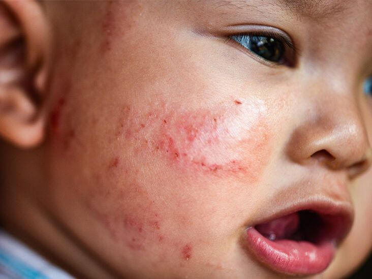 Is Your Baby's Skin Extra Sensitive? How to Know