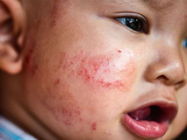 Is Your Baby's Skin Extra Sensitive? How to Know