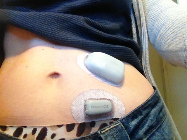 Insulin Pump: What to Know Before You Disconnect