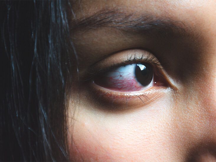 10 causes of eye watering and tearing and how to treat it