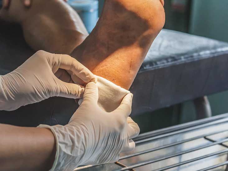 PDF) Retraction Note: Evaluation of low-cost custom made VAC therapy  compared with conventional wound dressings in the treatment of non-healing  lower limb ulcers in lower socio-economic group patients of Kashmir valley