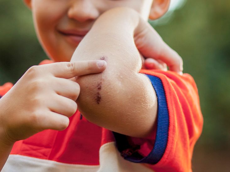 picking-scabs-how-to-stop-compulsive-picking-and-heal-scars