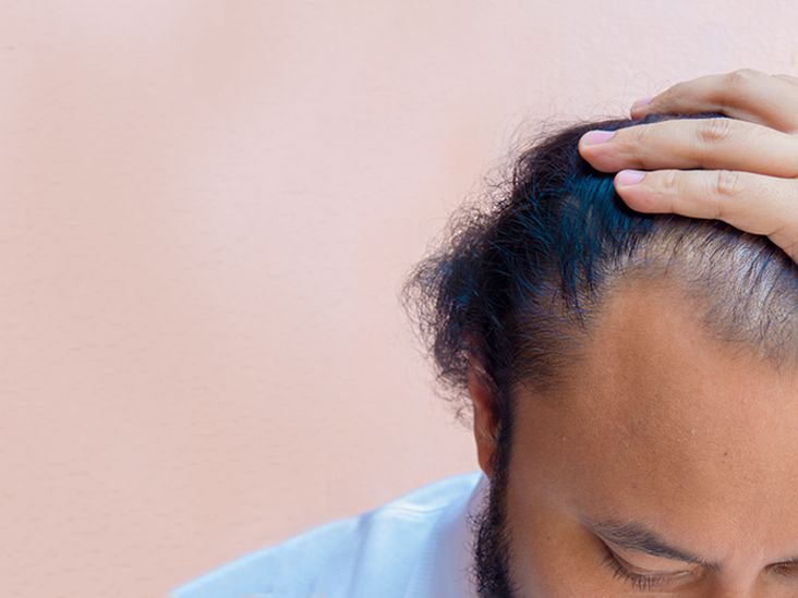 Key Issues Likely to Cause Hair Loss From High Stress Levels