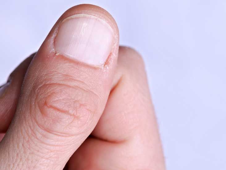 Spotted a red half moon on your nail? Could be a sign of Covid-19. Read  here to know more | Mint
