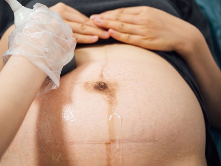 How Many C-Sections Can You Have?