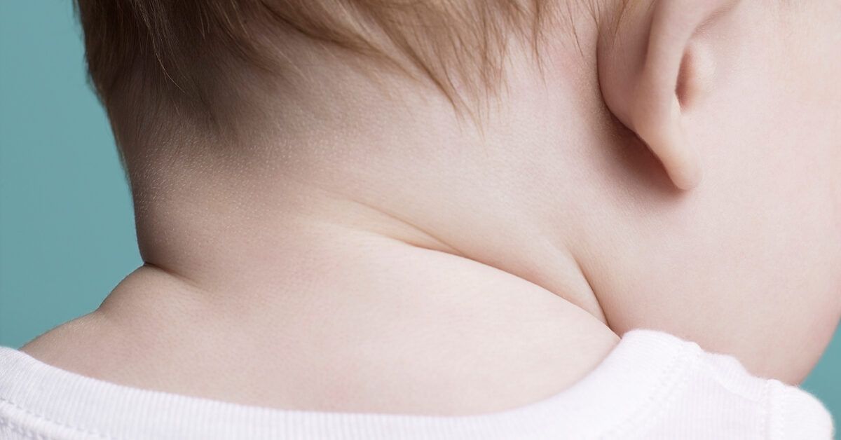 Baby Yeast Infection on the Neck: Causes and Treatment