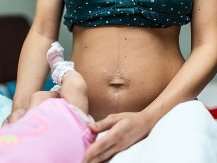 How to Tighten Belly Skin after Delivery