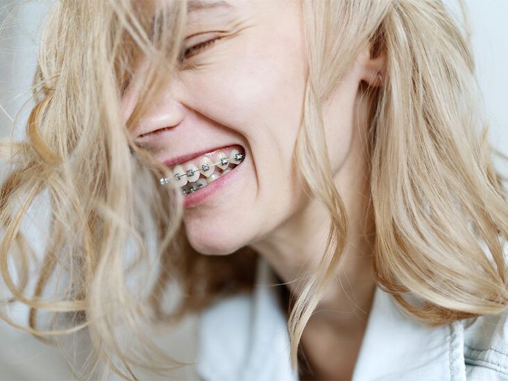 Why Do Braces Need Rubber Bands?