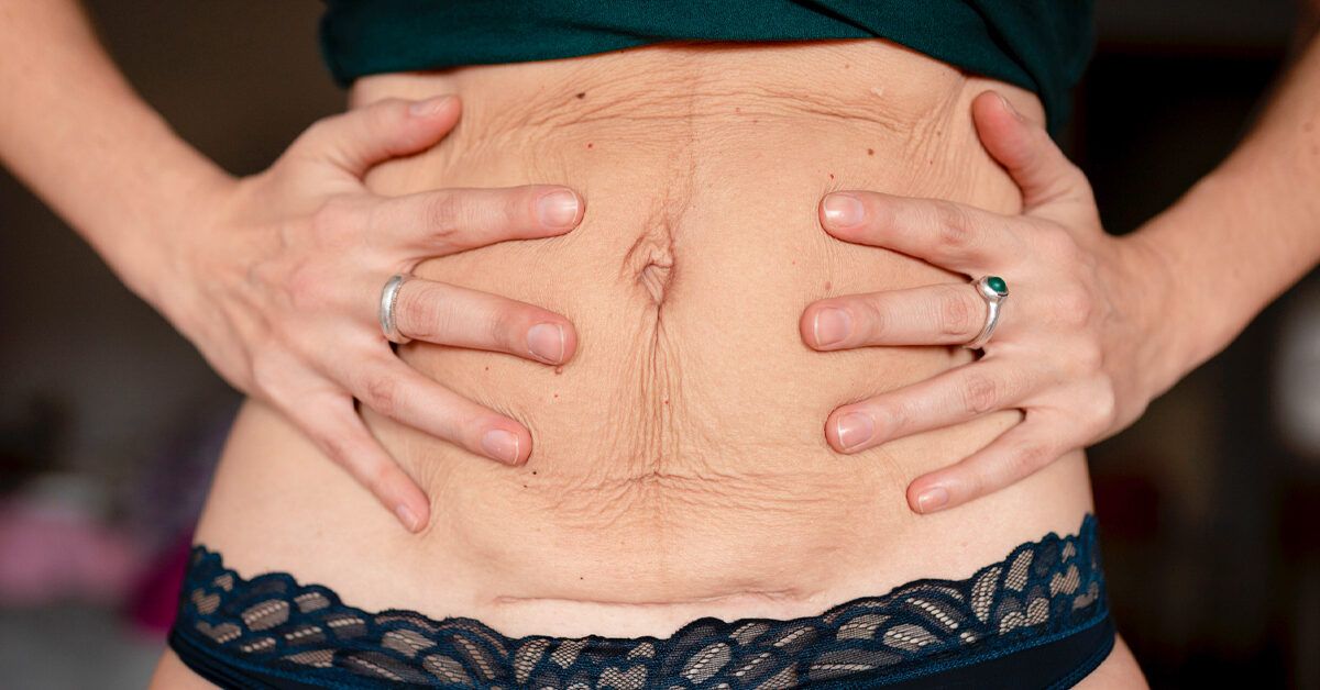 What Happens To The Belly Button After A Tummy Tuck?