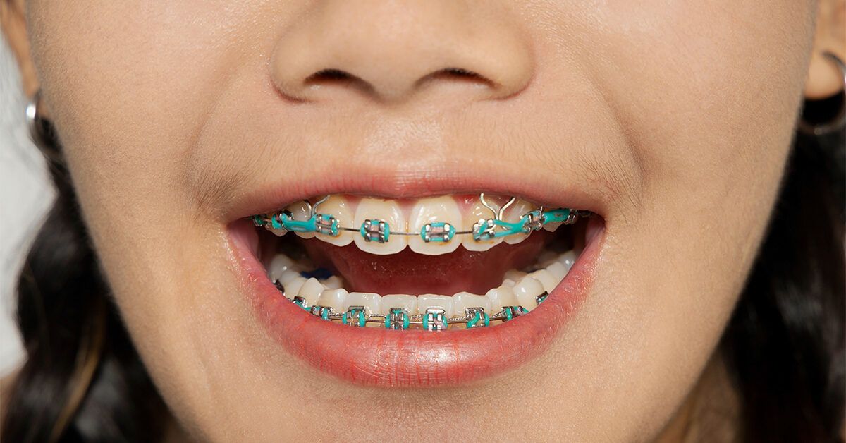 Dental Orthodontic Power Chain Elastic Rubber Bands For Braces  Long/Short/Closed