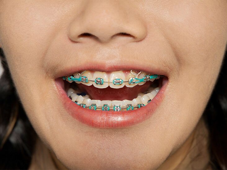 How elastics (rubber bands) SHOULD be used in orthodontics - Australian  Society of Orthodontists