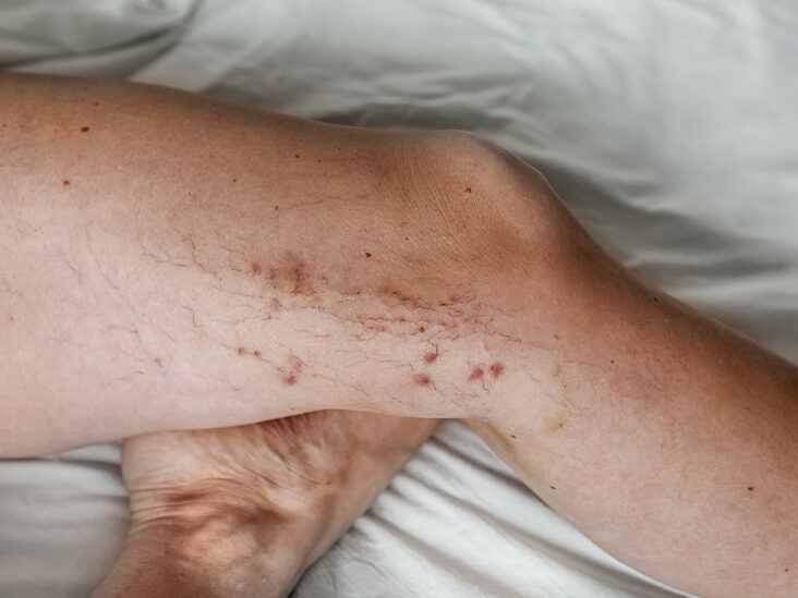 I have very visible green veins on my legs. Can these be treated? (photos)