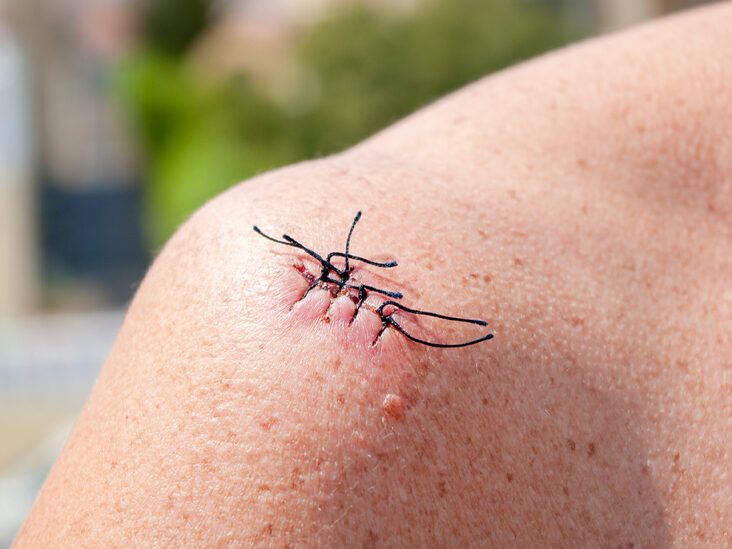 When to Get Stitches: How to Tell If Your Cut Needs Sewing Up