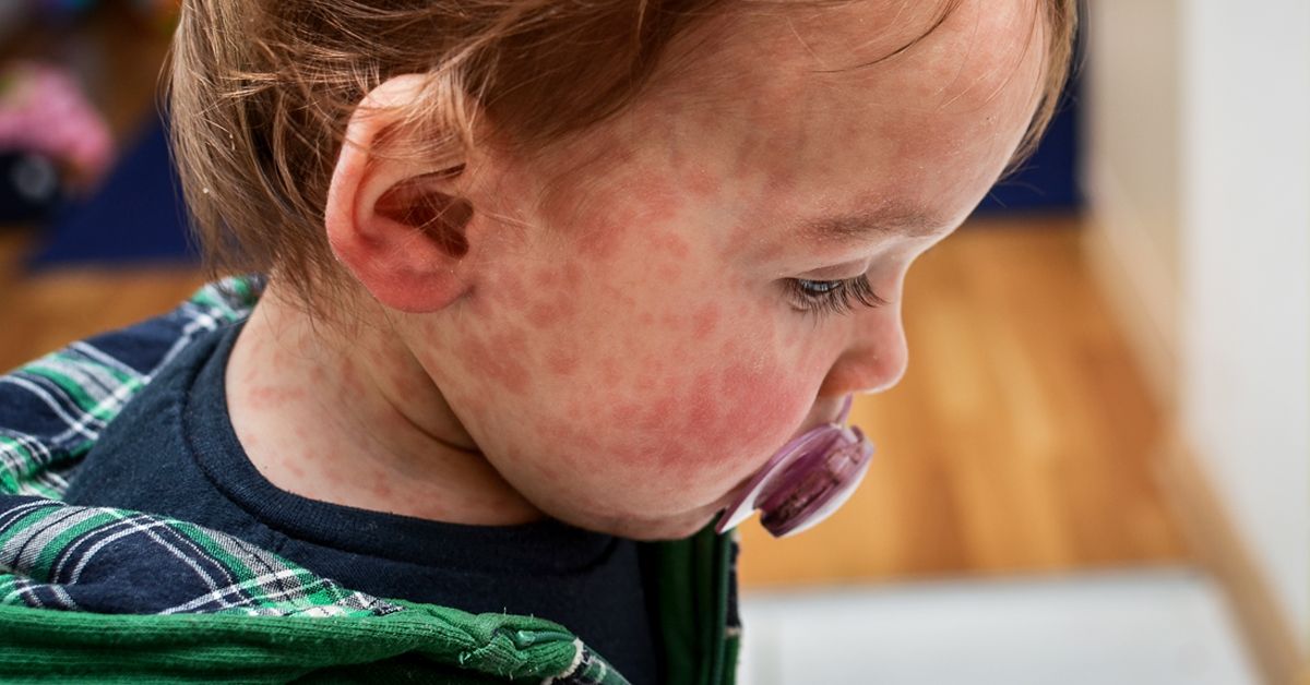 allergic reaction rash on babies