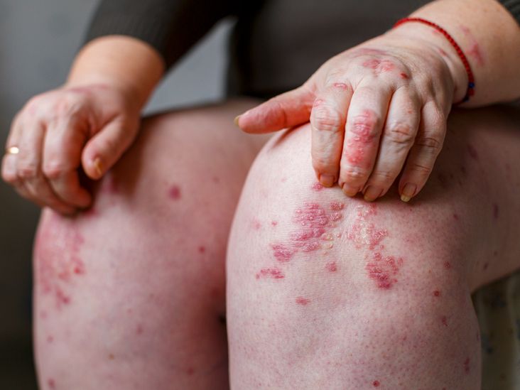 What Do Different Types of Psoriasis Rashes Look Like, and How Are They Treated?