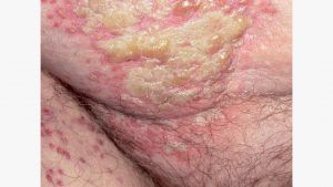 Shingles on Your Leg and Groin: Symptoms, Pictures, and Treatment