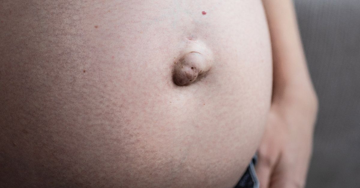 What is a postpartum umbilical hernia?
