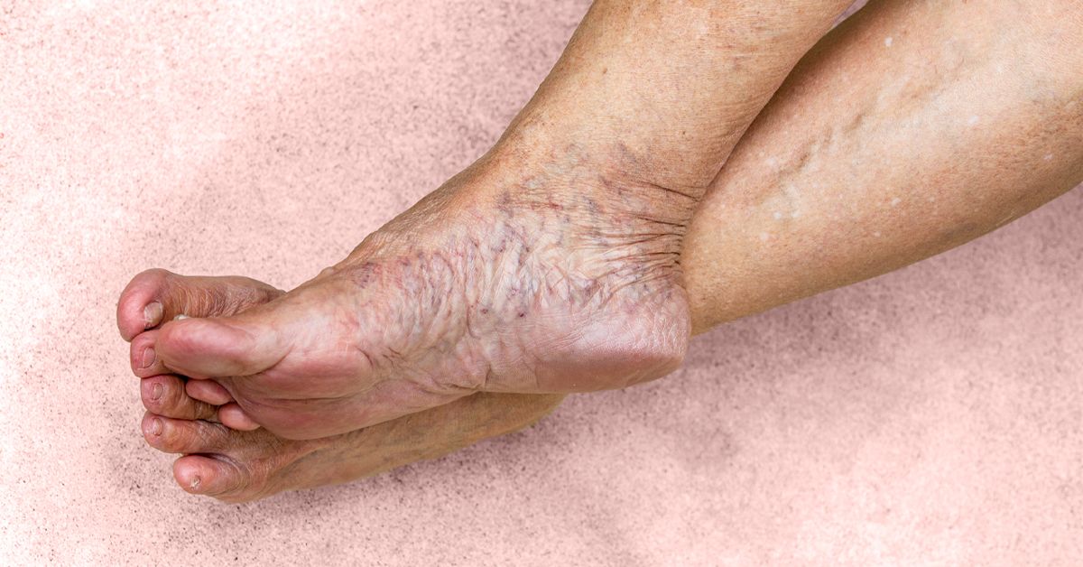 Varicose veins on a female senior legs. The stages of varicose veins. The  old age and