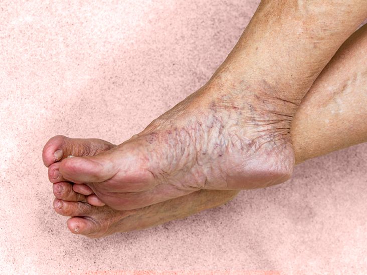 Understanding Venous Insufficiency: Causes, Symptoms, and