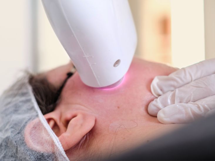 Melasma Laser Treatments Effectiveness, Types of Lasers, and More