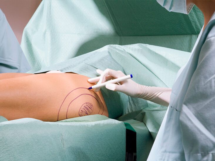 CoolSculpting vs. Liposuction: Cost, Side Effects, Pictures, More