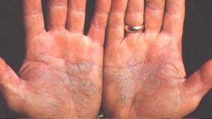 plaque psoriasis on hands