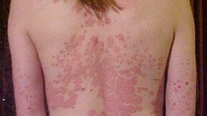 rash from psoriasis on back