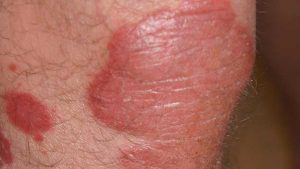 Psoriasis inflammation on knee