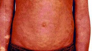 Milder erythrodermic psoriasis on torso