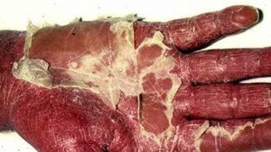 More severe erythrodermic psoriasis