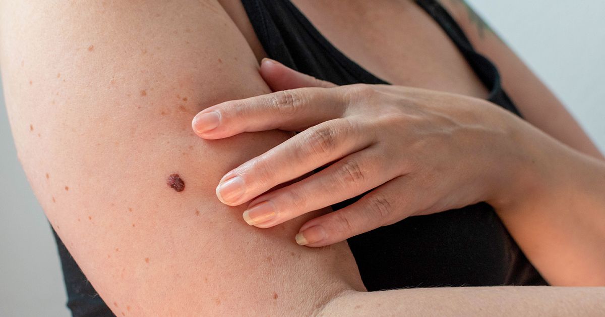 When Should You Be Concerned About a Crusty Mole?