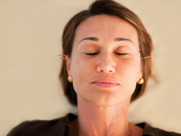 Acupuncture for Menopause: How This Alternative Therapy Brought Me Relief