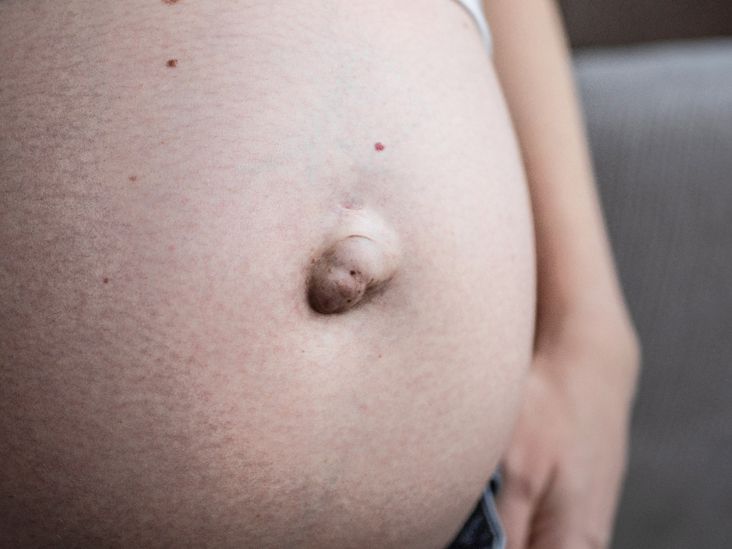 Postpartum Umbilical Hernia: Should I Have Surgery?