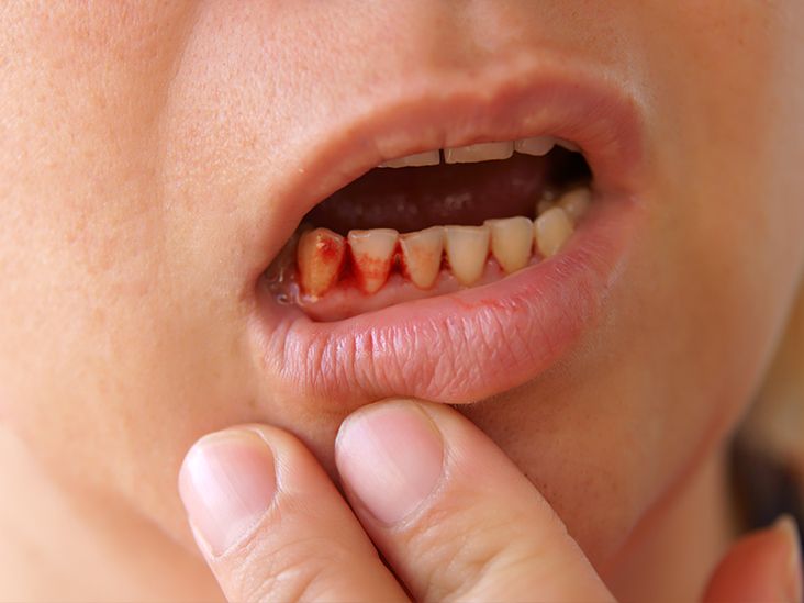 how to get rid of canker sores under tongue