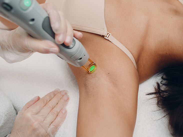 Discover 146+ laser hair removal side effects best