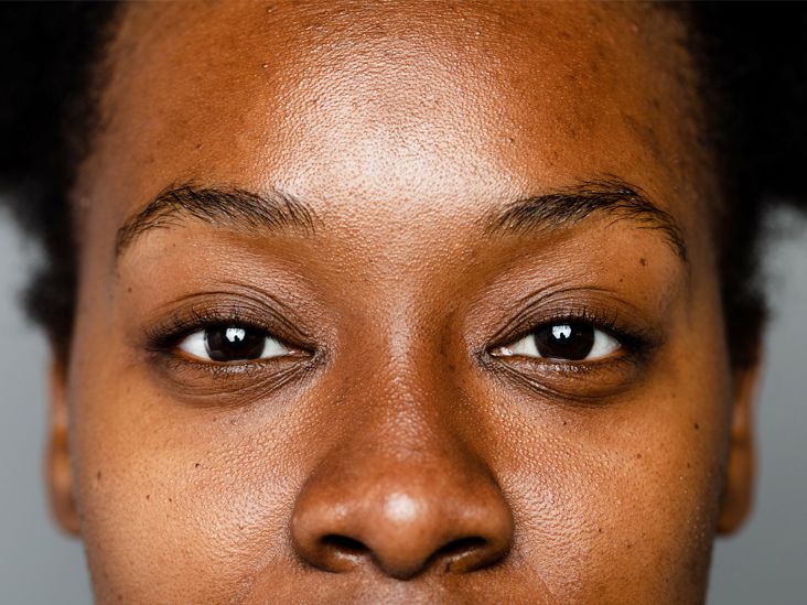 Blackheads on Black Skin: Treatment and Prevention Recommendations