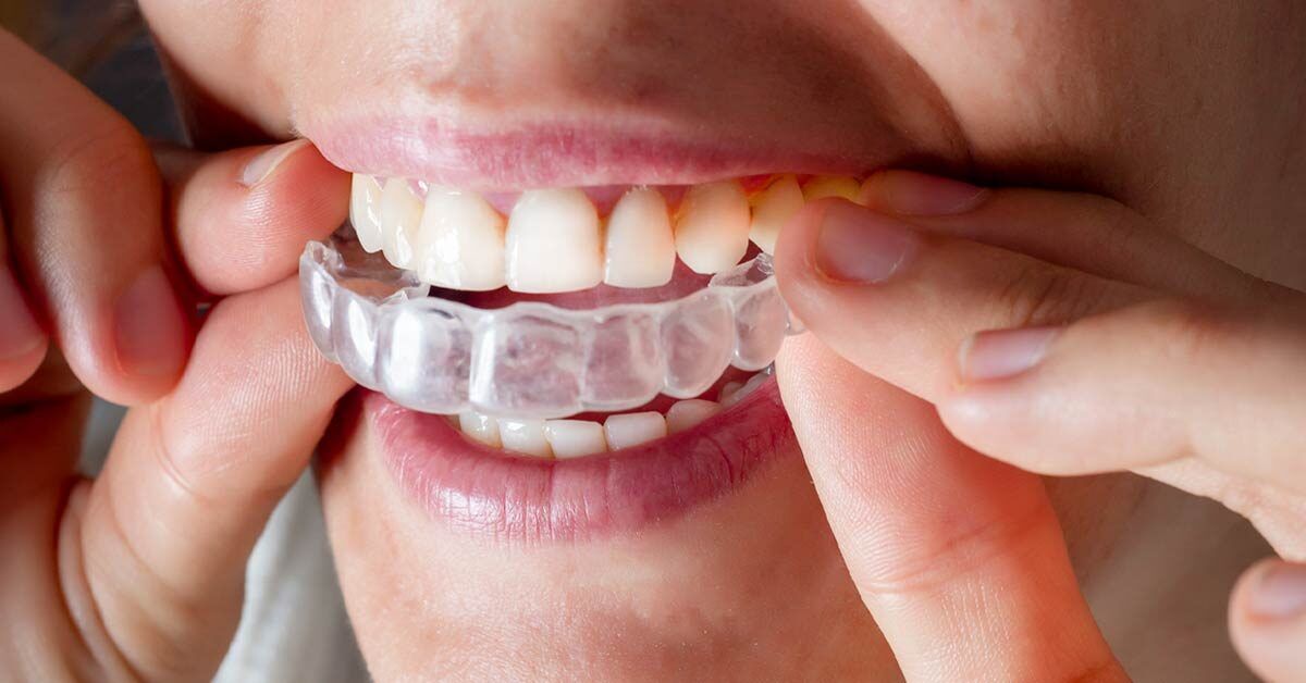 What to Know About Invisible Braces