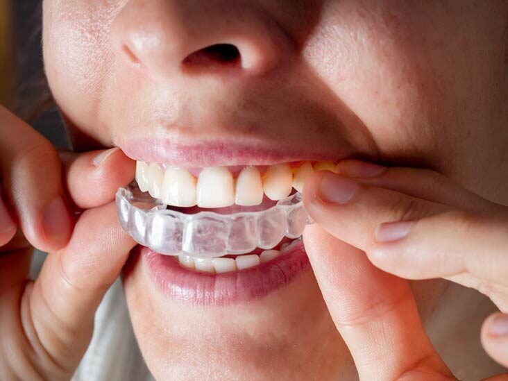 Invisalign attachments are small buttons that help your aligners