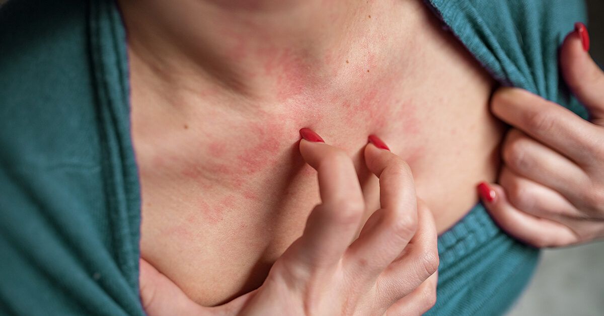 Picture included: Exclusively pumping itchy rash on breasts