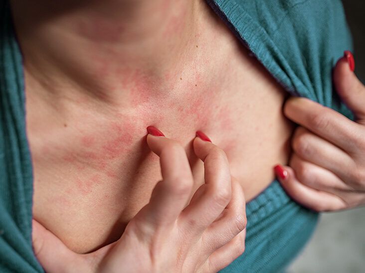 What Is That Rash Under Your Breasts? Experts Reveal Two Common Causes