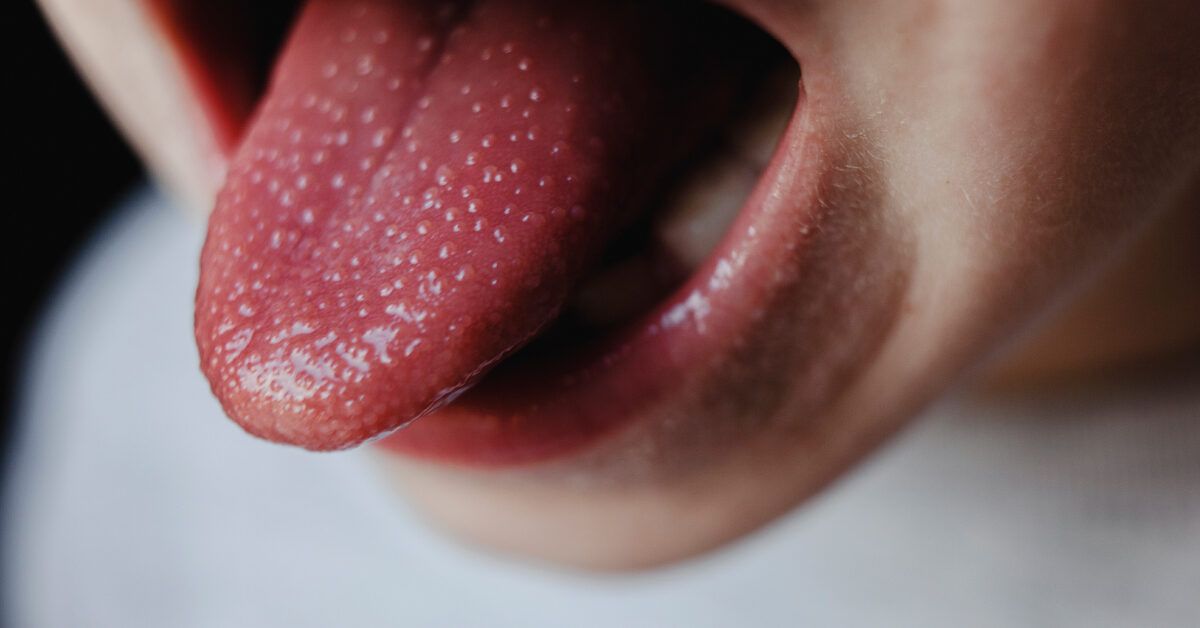 Big Tongue (Macroglossia) Symptoms, Causes, and Treatment