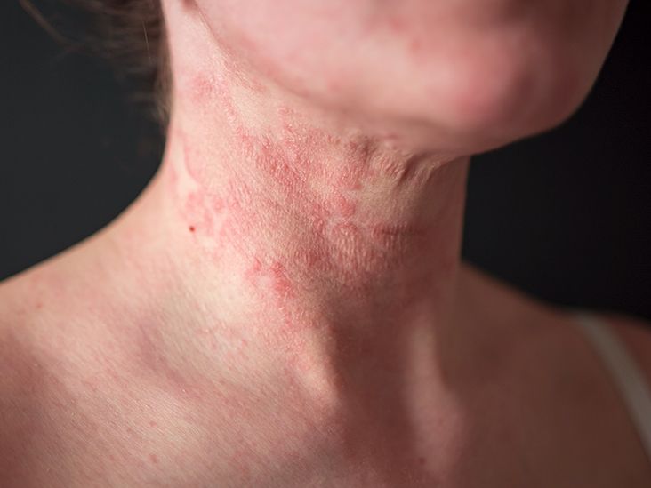 Eczema Facts, Stats, and More