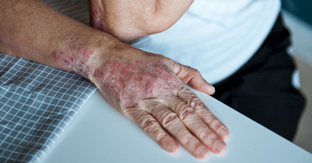 Psoriasis Rash Types, Pictures, and More