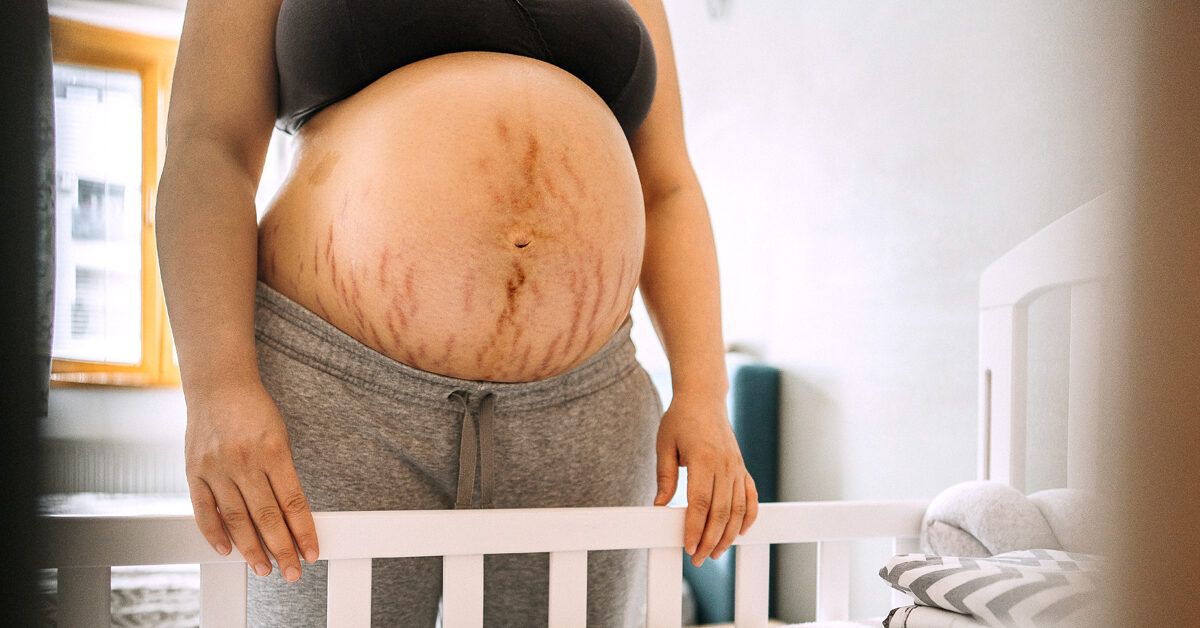 stretch marks after twin pregnancy