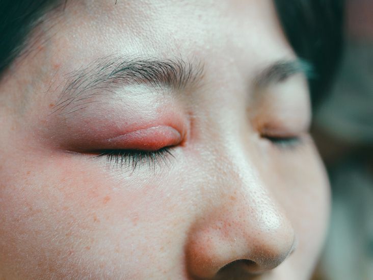 Spider Bite On An Eyelid Symptoms Treatment Getting Help 