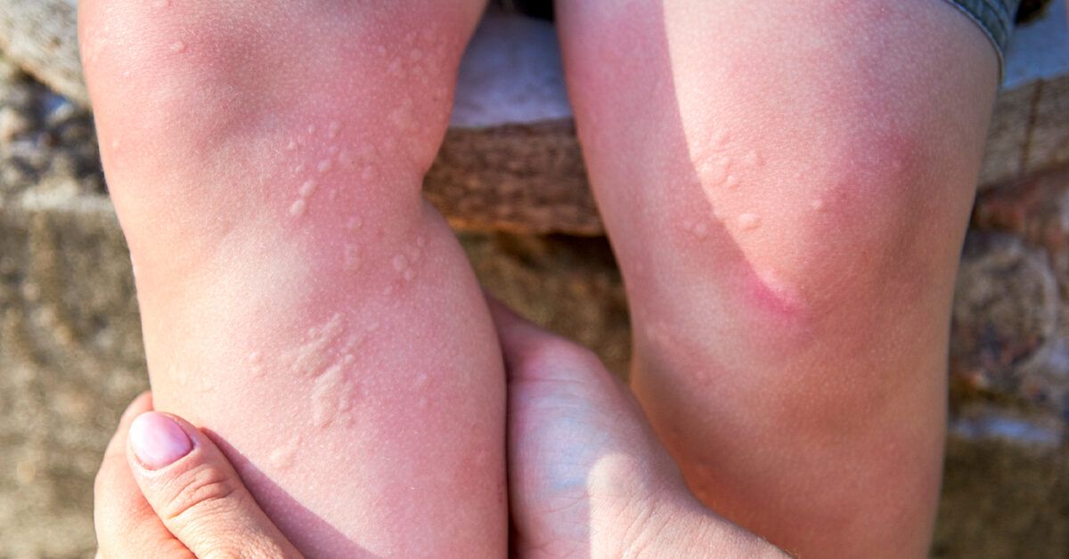 7 Reasons Why You Might Be Breaking Out in Hives