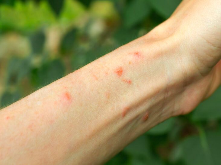 When to Worry About a Rash in Adults