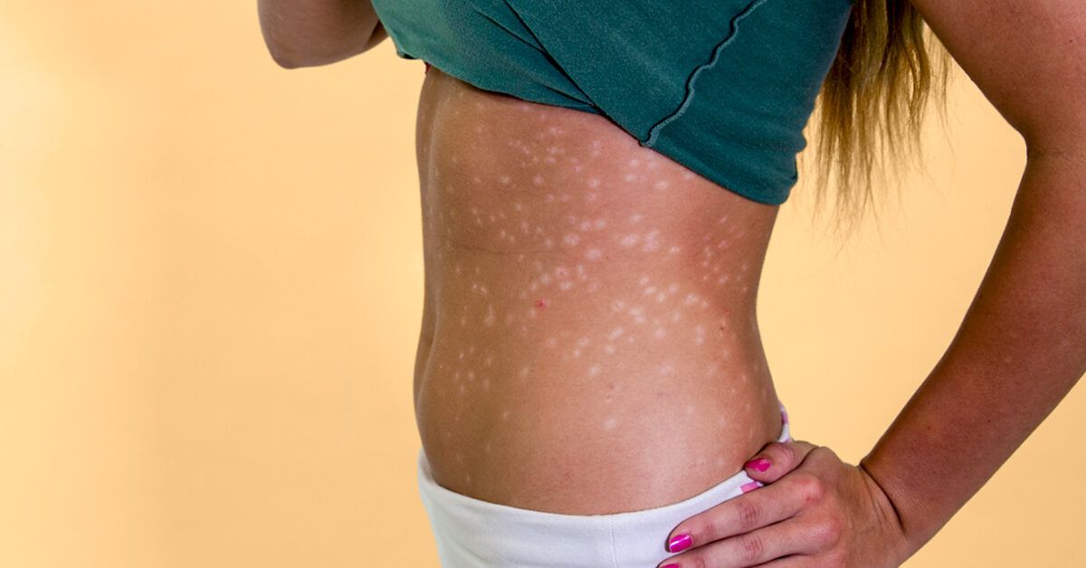 Woman With Psoriasis Guttate Scars 1200x628 Facebook 1200x628 