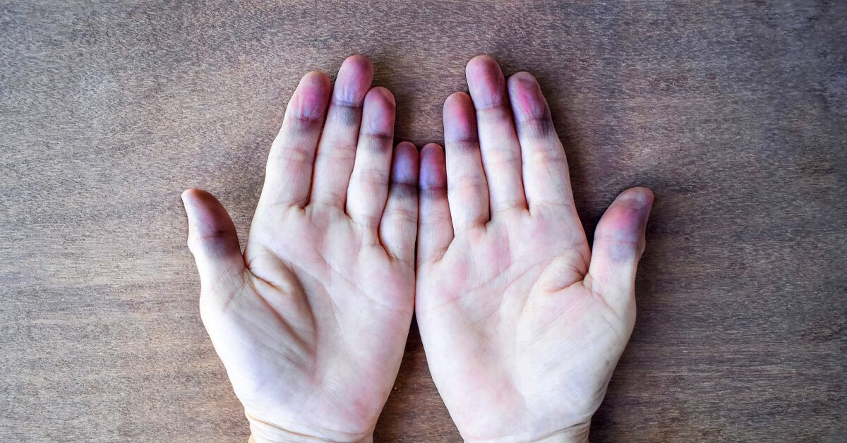 Cyanotic hands or peripheral cyanosis or blue hands facebook