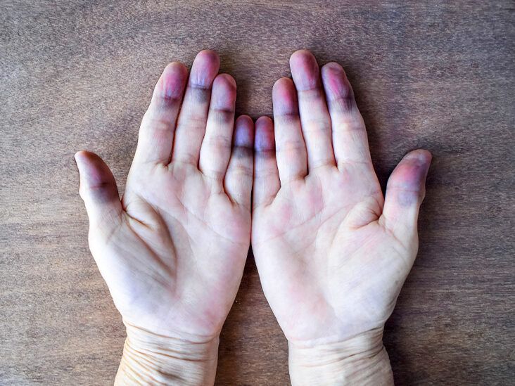 Peripheral Cyanosis (Blue Hands and Feet): Causes and More